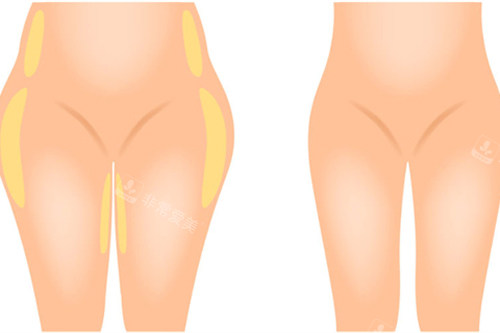 臀部吸脂手术前后对比图