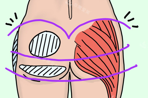 提臀术需要改善的位置图解