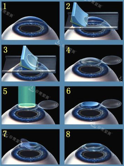 近视手术过程图
