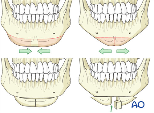 下巴截骨手术方式