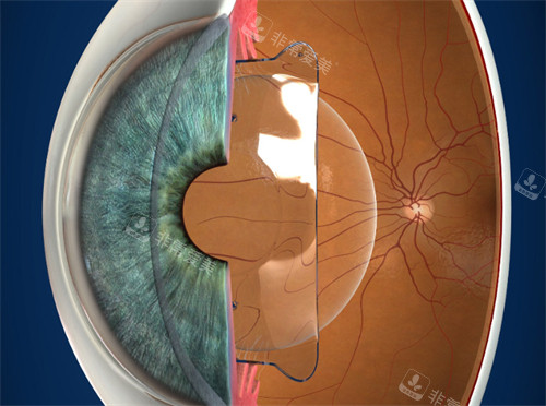 晶体植入在眼睛里的层次