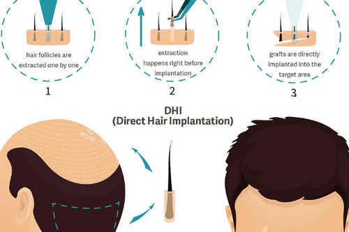 DHI植发过程图解