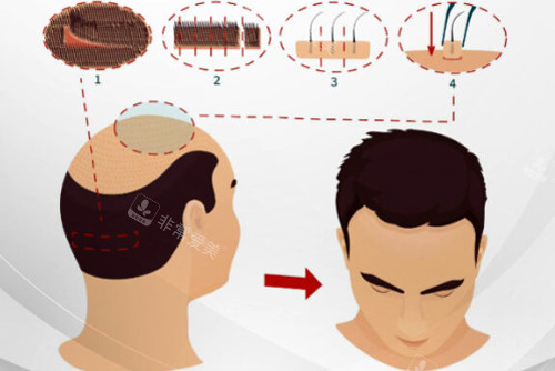 植发过程图解