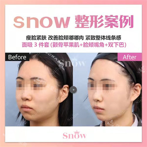 韓國(guó)snow整形面吸45度對(duì)比 韓國(guó)snow整形面吸45度對(duì)比