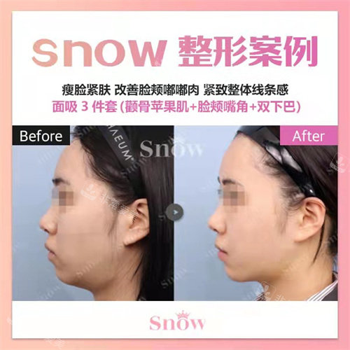 韓國(guó)snow整形面吸側(cè)面對(duì)比 韓國(guó)snow整形面吸側(cè)面對(duì)比