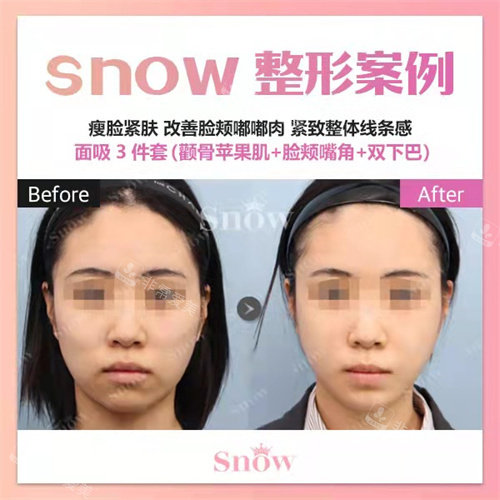 韓國(guó)snow整形面吸正面對(duì)比 韓國(guó)snow整形面吸正面對(duì)比
