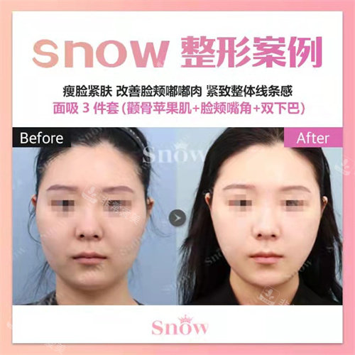 韓國snow整形面吸正面對比 韓國snow整形面吸正面對比