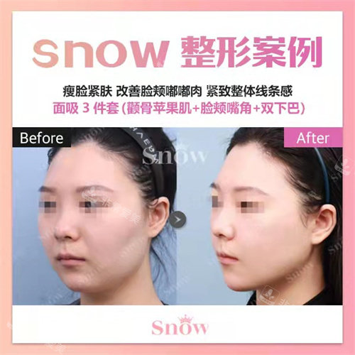 韓國snow整形面吸45度對比 韓國snow整形面吸45度對比