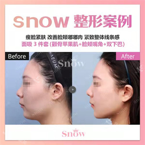 韓國snow整形面吸側(cè)面對比