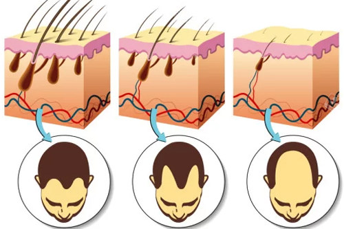 不同程度脱发毛囊的样子图解