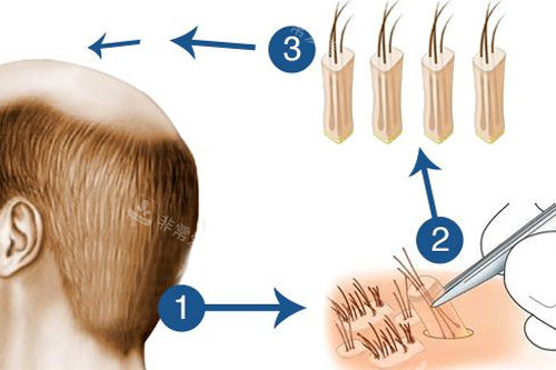 植发过程图解