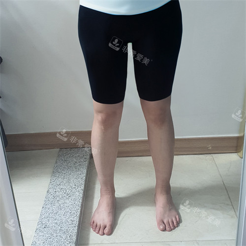 韓國普蘭斯醫(yī)院瘦腿后 韓國普蘭斯醫(yī)院瘦腿后