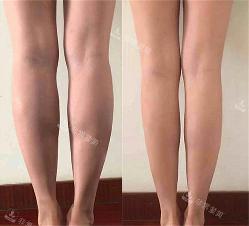 韩国普兰斯肌肉腿消失术前后对比