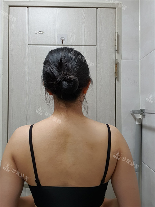 韓國普蘭斯醫(yī)院薄背手術(shù)前 韓國普蘭斯醫(yī)院薄背手術(shù)前