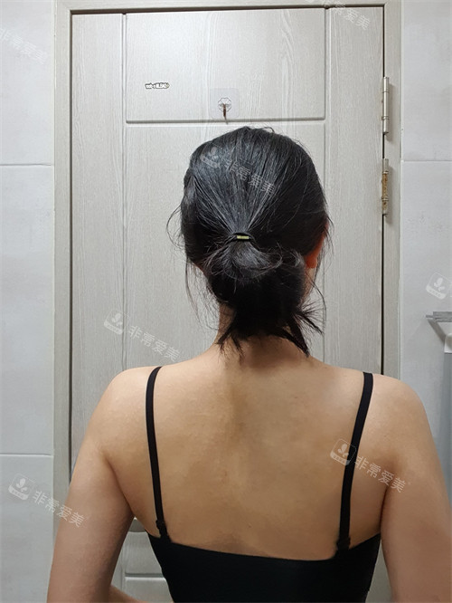 韓國普蘭斯薄背手術(shù)后 韓國普蘭斯薄背手術(shù)后