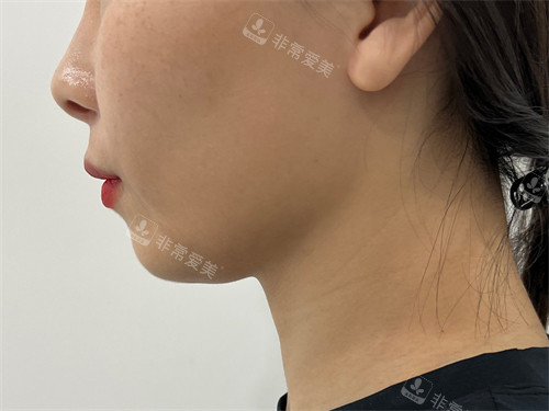 韩国普兰斯医院钛激光提升下颌线前