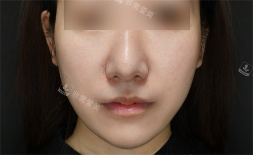 在韩国普兰斯医院用钛提升瘦脸后