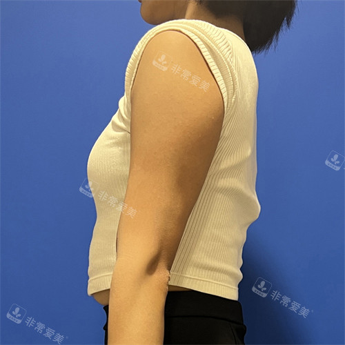 在韓國(guó)普蘭斯醫(yī)院注射脂肪分解針前