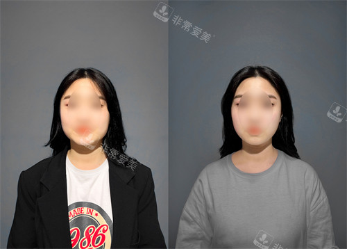 韓國普蘭斯醫(yī)院鈦提升前后對比圖 韓國普蘭斯醫(yī)院鈦提升前后對比圖