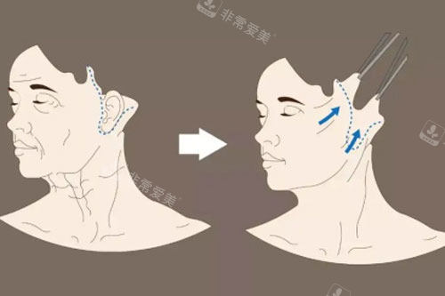 面部除皱示意图