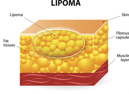 皮下脂肪结构