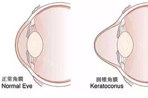 正常角膜与圆锥角膜