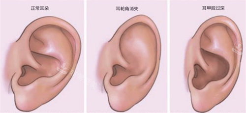 耳朵的三种形态
