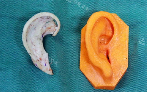 耳畸形修复手术模型图