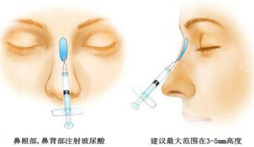 玻尿酸注射隆鼻