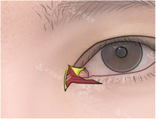 双重皮瓣修复内眼角皮瓣剥离图示