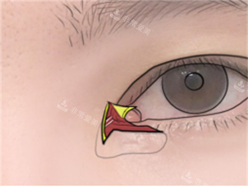 双重皮瓣修复内眼角皮瓣剥离示意图