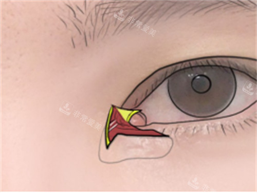 雙重皮瓣修復(fù)內(nèi)眼角皮瓣剝離示意圖