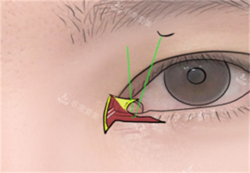 双重皮瓣修复内眼角皮瓣剥离缝合图示