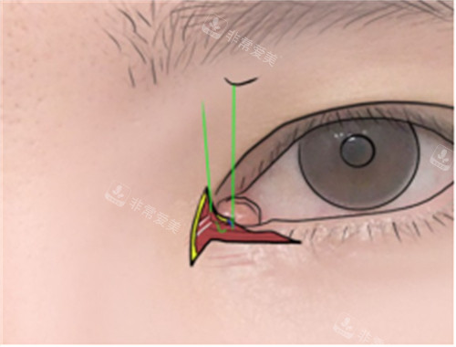 双重皮瓣修复内眼角内缝合图示