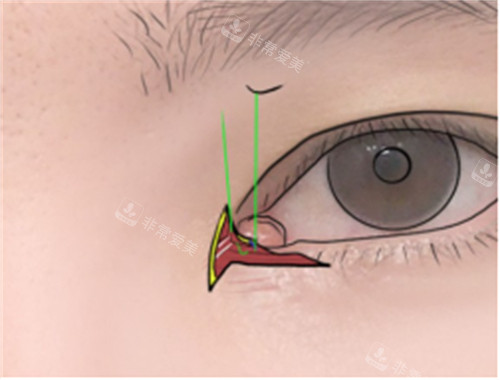 雙重皮瓣修復(fù)內(nèi)眼角內(nèi)縫合圖示