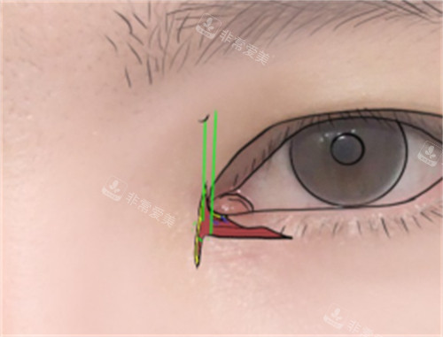 双重皮瓣修复内眼角缝合展示图