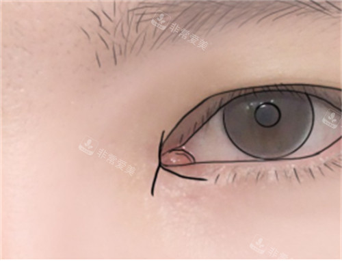 双重皮瓣修复内眼角缝合过程