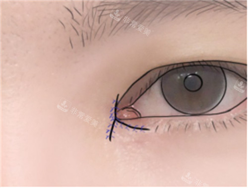 双重皮瓣修复内眼角缝合图示