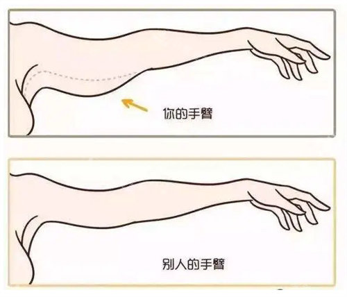 酷塑冷凍吸脂手臂 酷塑冷凍吸脂手臂
