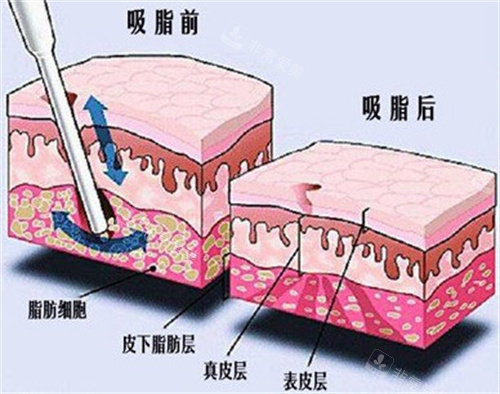 吸脂之后的脂肪