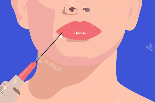 微整形-玻尿酸丰唇过程图解
