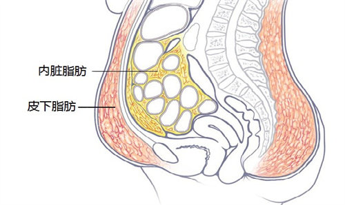 抽脂后小腹突出