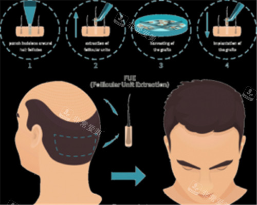 植发过程图示