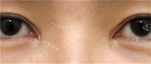 韓國SONE整形外科眼修復手術(shù)前 韓國SONE整形外科眼修復手術(shù)前