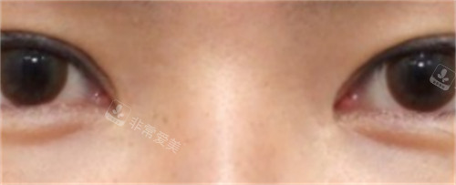 韓國SONE整形外科眼修復后睜眼狀態(tài) 韓國SONE整形外科眼修復后睜眼狀態(tài)