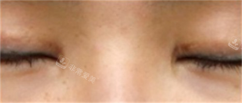 韓國SONE整形外科眼修復前閉眼狀態(tài) 韓國SONE整形外科眼修復前閉眼狀態(tài)