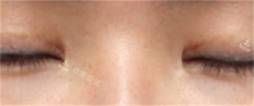 韓國SONE整形外科眼修復后閉眼狀態(tài) 韓國SONE整形外科眼修復后閉眼狀態(tài)