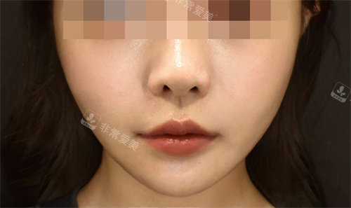鈦提升面部后 鈦提升面部后