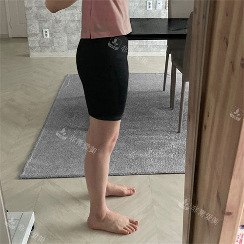 脂肪分解針大腿術(shù)后 脂肪分解針大腿術(shù)后