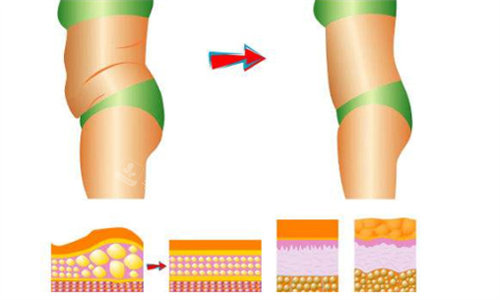 腹部吸脂前后对比图